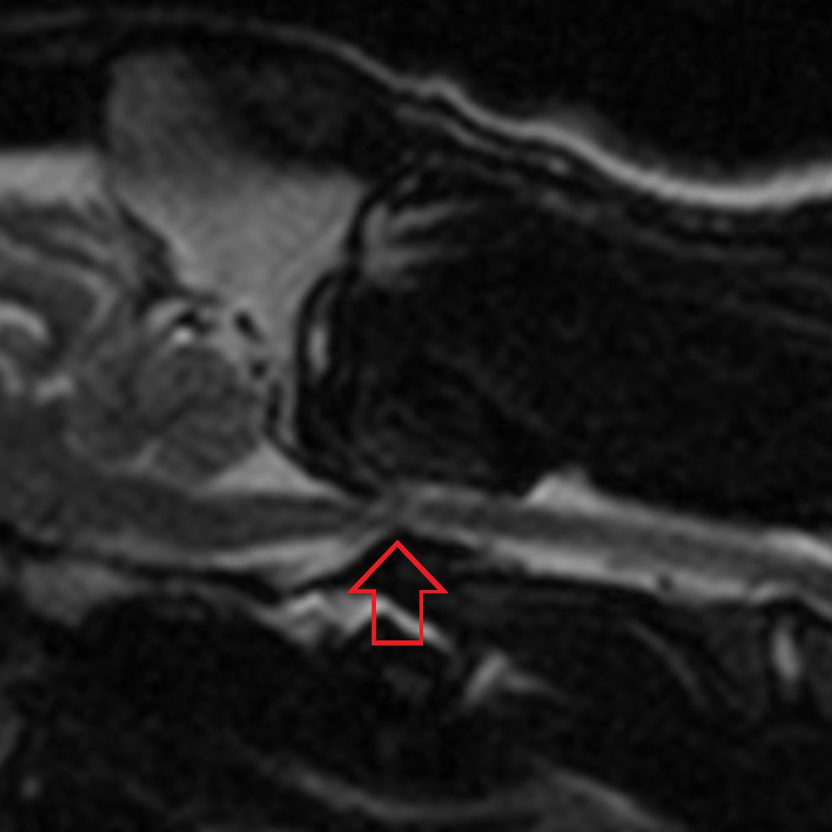 Мрт в 2 года. Т2 мрт спинной мозг. Мрт т2 режим. Сагиттальная проекция мрт. Мрт Атланта.