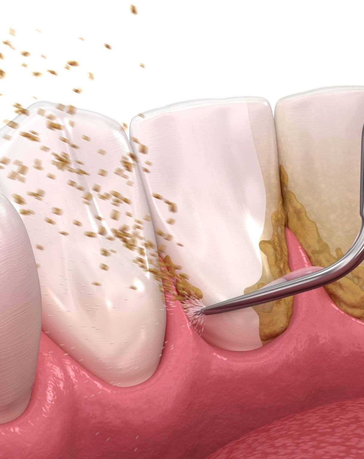 Правда или миф: удалять зубные отложения ОБЯЗАТЕЛЬНО каждые      6 месяцев!?