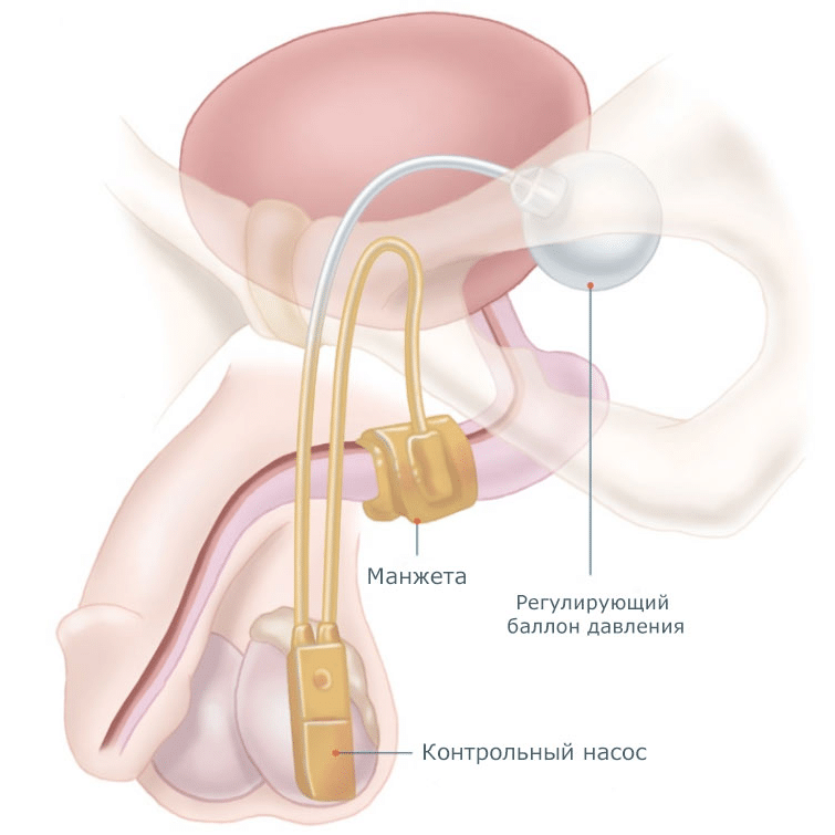 Механизм работы искусственного сфинктера мочевого пузыря