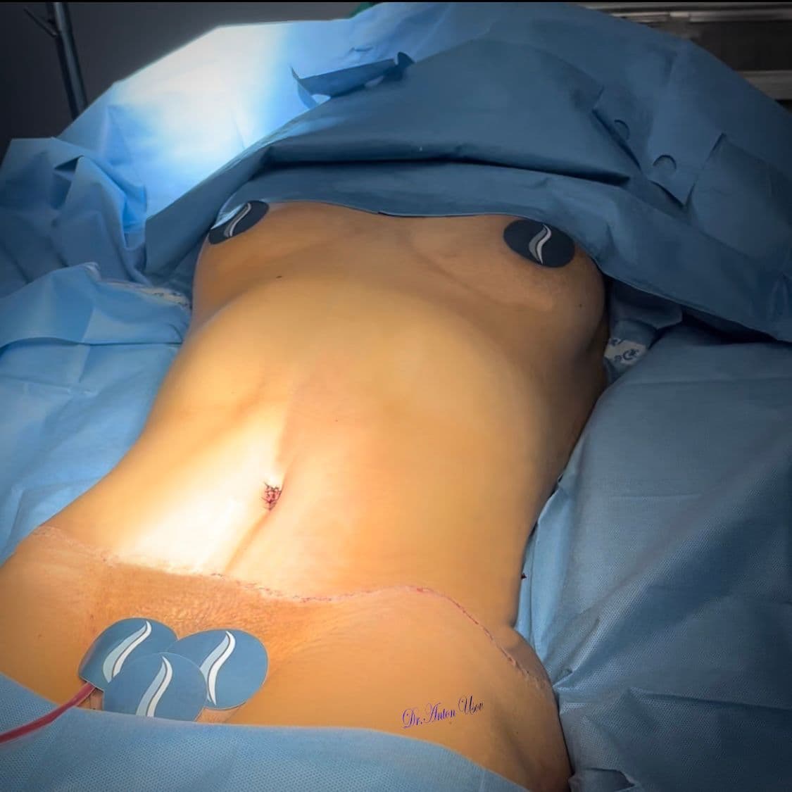 Купить Abdominoplasty