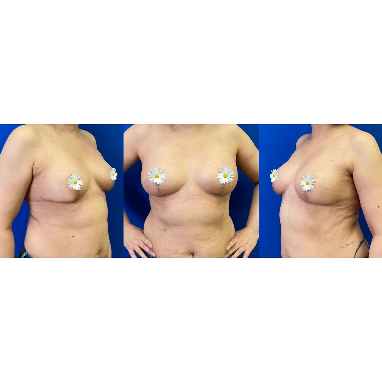 Купить Oncoplastic breast resection + symmetrization